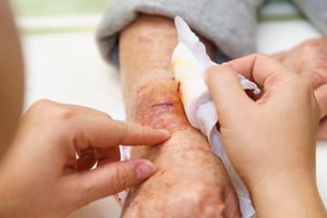 Herinneringen voor eenvoudige en complexe wondzorg